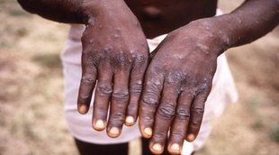 Monkeypox in India | Monkeypox | Monkeypox UP Alert