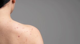 Acne On Back, Acne On Shoulder, Acne And Pimples,