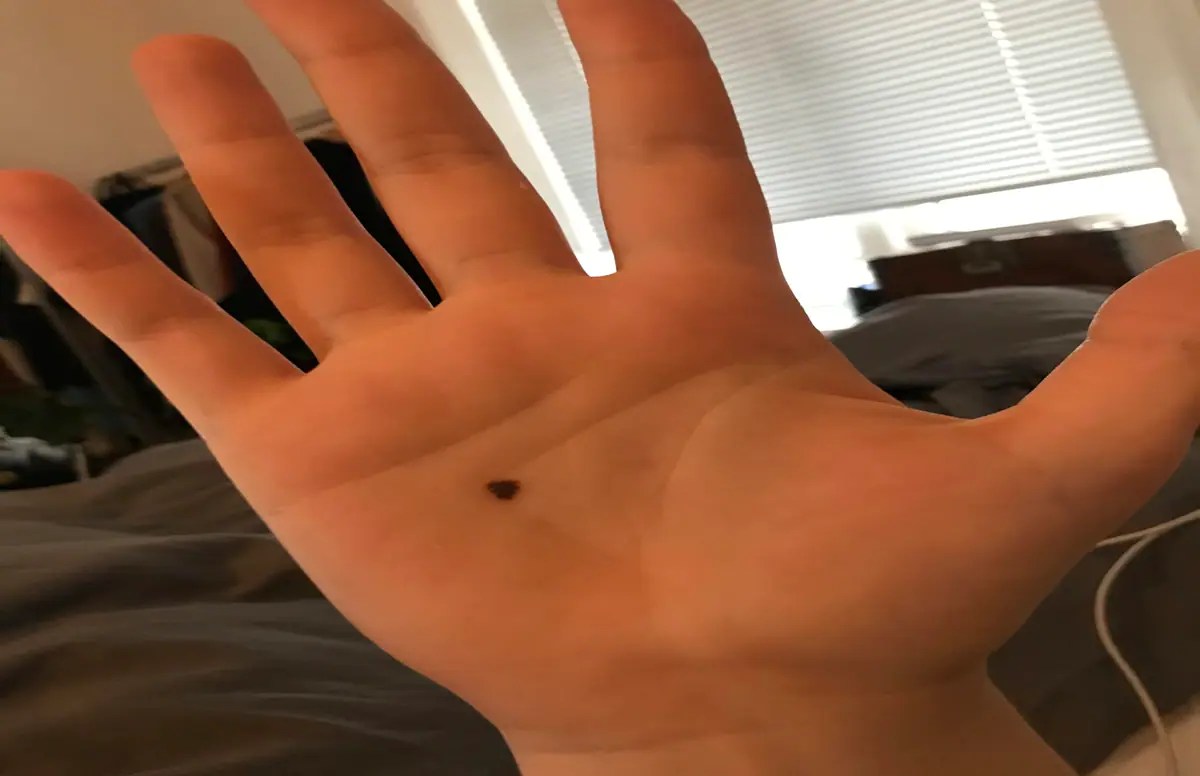 mole on palm, , mole on palm