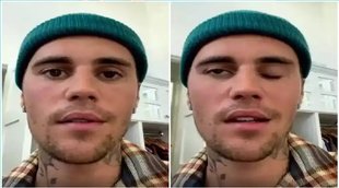 Ramsay Hunt Syndrome | Justin Bieber Paralysis | Justin Bieber Health