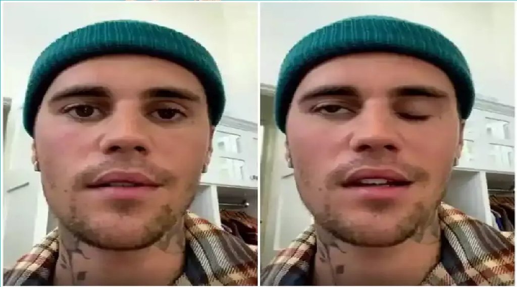 Ramsay Hunt Syndrome | Justin Bieber Paralysis | Justin Bieber Health