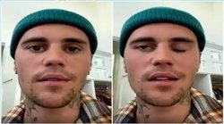 Ramsay Hunt Syndrome: अमेरिका के फेमस सिंगर जस्टिन बीबर नहीं झपका पा रहे आंखें, जानें इस बीमारी के लक्षण और कारण