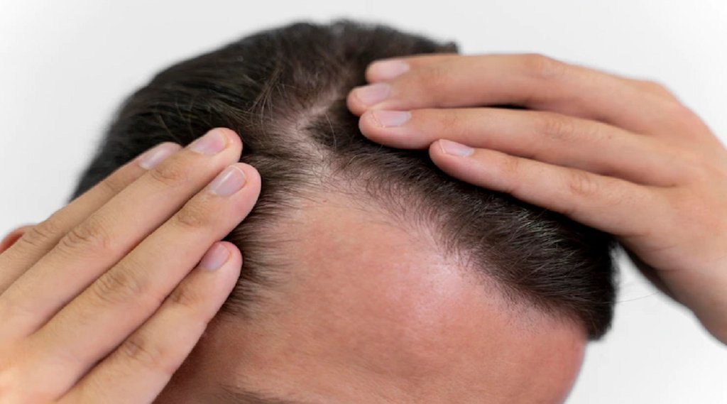 balding cause,Treatments,Prevention,