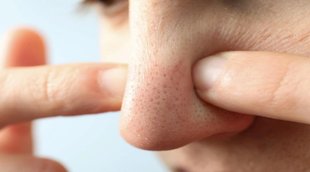Blackheads Cure, skin care, skin care tips,coconut oil and baking powder mask,