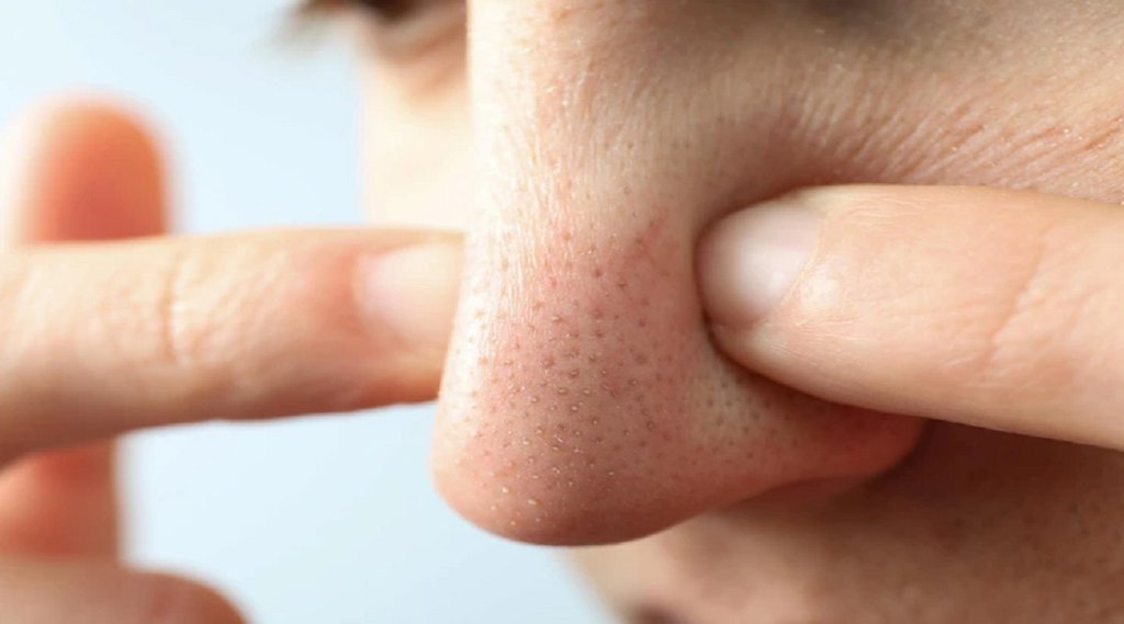 Blackheads Cure, skin care, skin care tips,coconut oil and baking powder mask,
