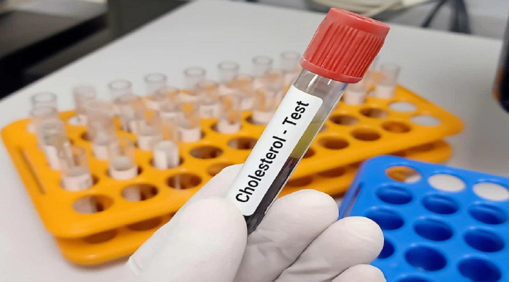 high cholesterol,foods list,high colestrol foods avoid