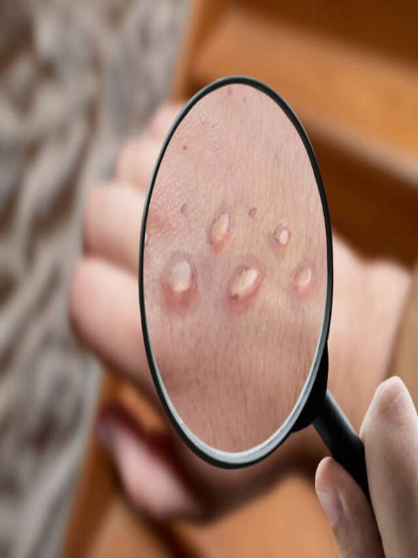 6 FOODS WHICH CAN SAVE YOU FROM MONKEYPOX