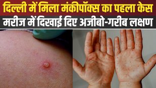 monkeypox virus symptoms