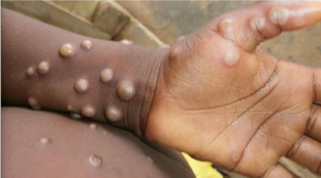 Monkeypox, First Death from Monkeypox, Kerala Government