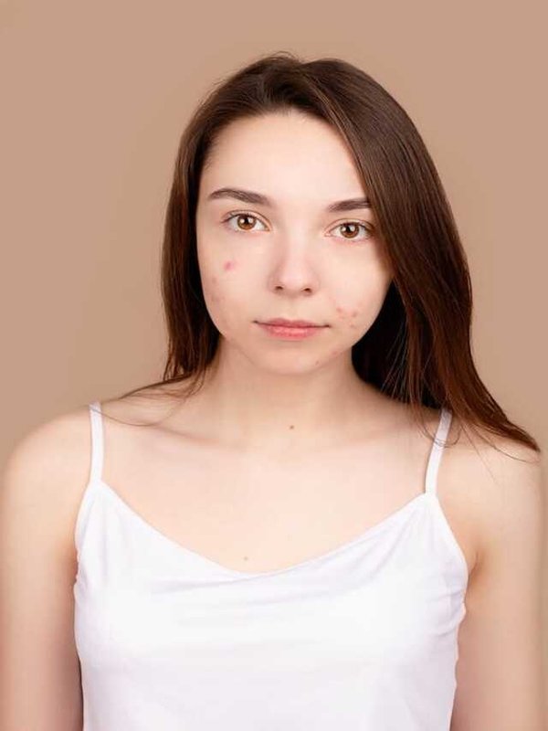 SKIN CARE TIPS FOR PERIOD DAYS - PIMPLES ISSUE