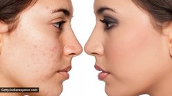 Skin Care: मुंहासों से हैं परेशान? जानिये गर्मी में कैसा होना चाहिये स्किनकेयर रूटीन