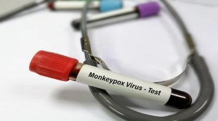 Monkeypox vs Chickenpox,Monkeypox and Chickenpox Difference