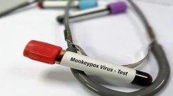 Monkeypox Symptoms: बुखार, सिरदर्द और पीठ दर्द कहीं मंकीपॉक्स तो नहीं? जानिये इस बीमारी के लक्षण और उपचार