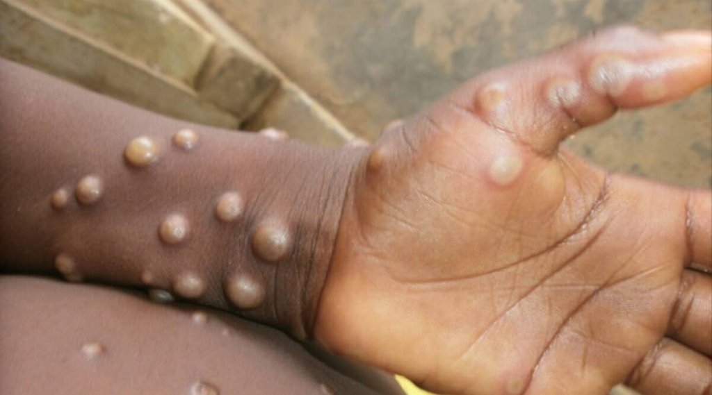 monkeypox