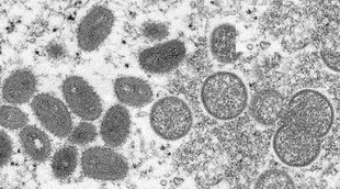 Monkeypox, Kerala, UAE