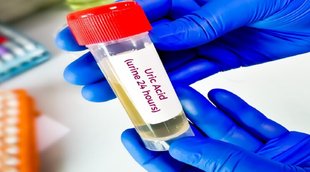 uric acid ,joint pain