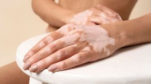 vitiligo treatment naturally, tips for white spots