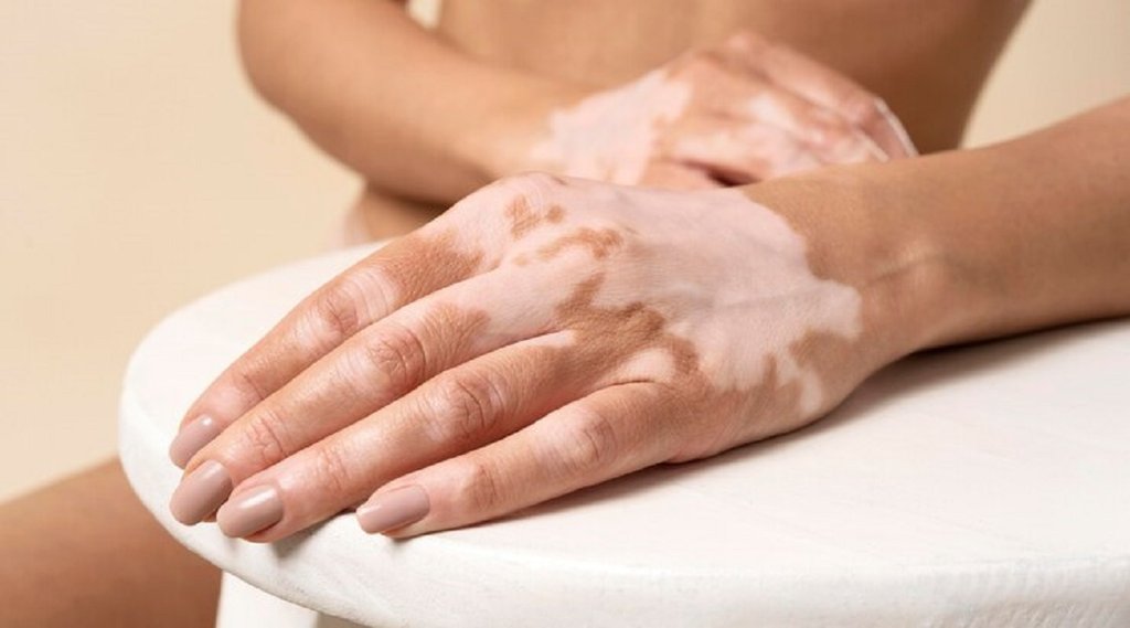 vitiligo treatment naturally, tips for white spots