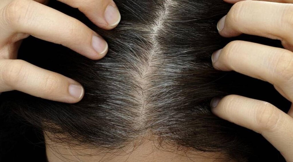 white hair | Hair Problem | White Hair Fall