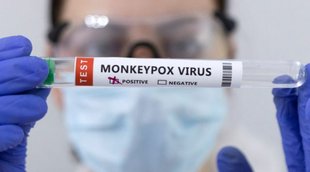 monkeypox | monkeypox symptoms | monkeypox death
