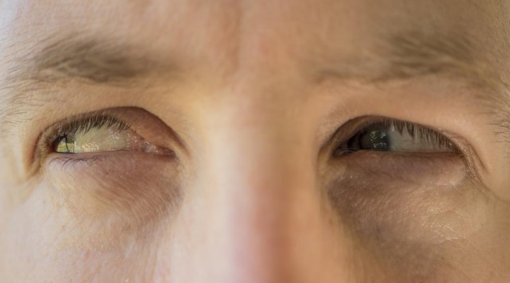 type 2 diabetes, xanthelasma in hindi, skin patches, blood sugar, glucose in hindi
