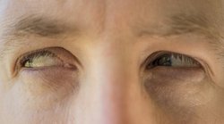 Cholesterol Levels: आंखों में ये 3 बदलाव बढ़े हुए कोलेस्ट्रॉल का देते हैं संकेत; इसे खाने से घट सकता है खराब कोलेस्ट्रॉल