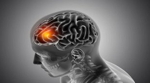 BrainStroke, Stroke symptoms, stroke causes