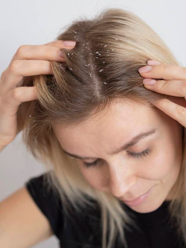 dandruff