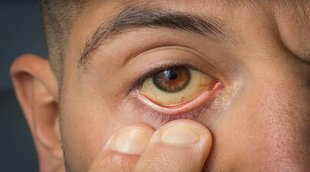 Yellow eyes may be symptoms of jaundice, jaundice symptoms,