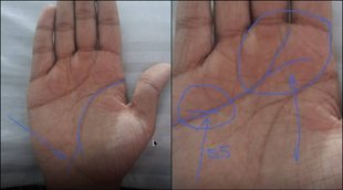mole in palm, mole prediction