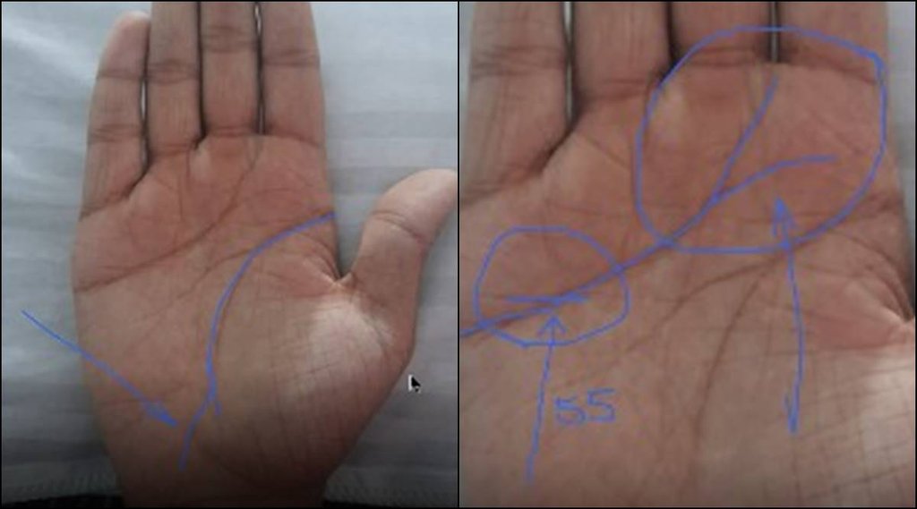 mole in palm, mole prediction