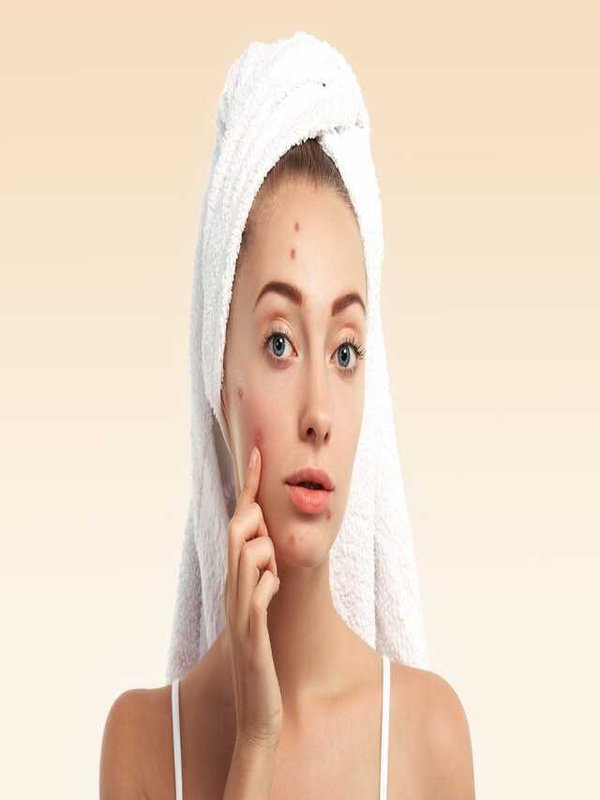 TIPS TO GET RID OF PIMPLES IN MONSOON