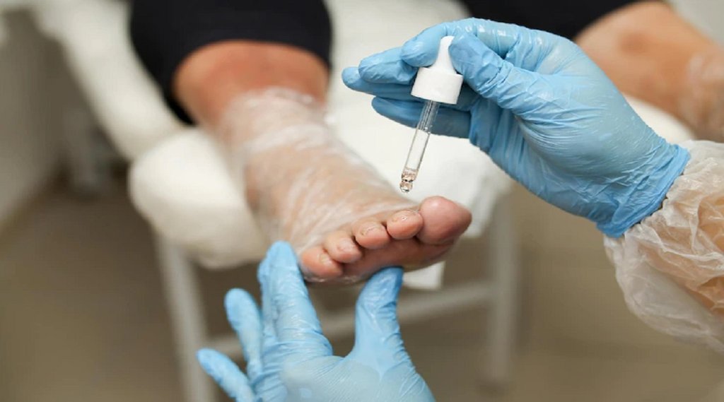 Fungal Infection, Skin fungal infection, types of fungal infection,