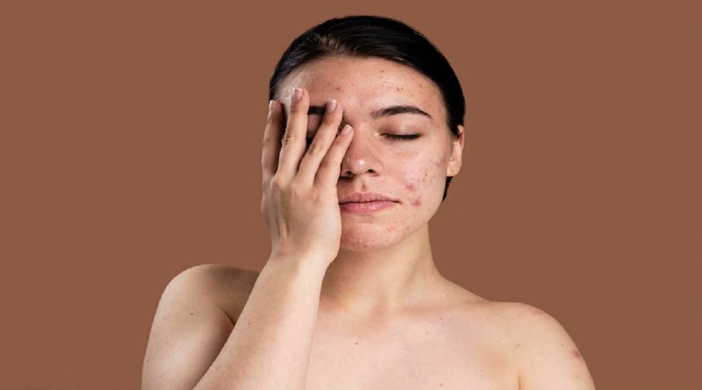 boil, baba ramdev, skin care