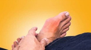 Uric Acid, arhritis, Health