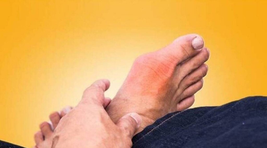 Uric Acid, arhritis, Health