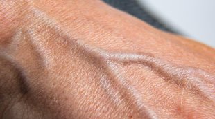 Swollen Veins in Hands Cause,Swollen Veins in Hands symptoms,Swollen Veins cure