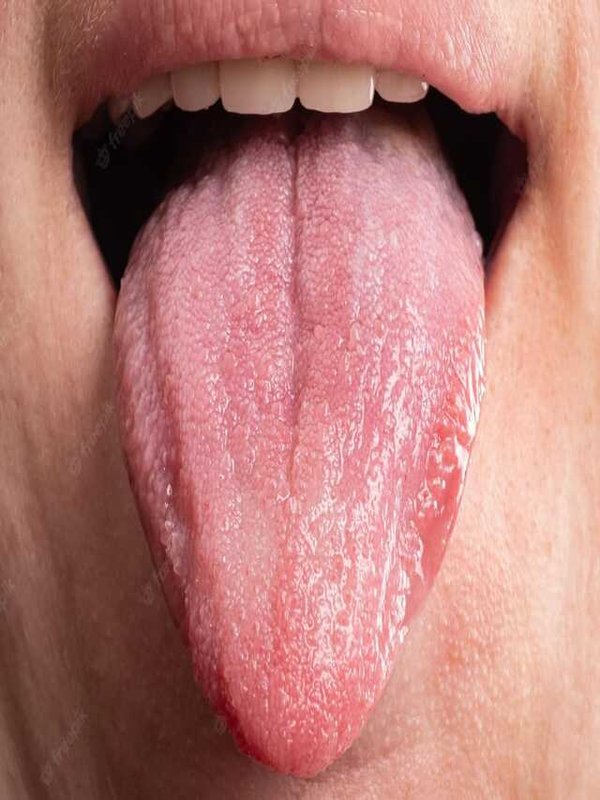 TONGUE ULCER - HOME REMEDIES