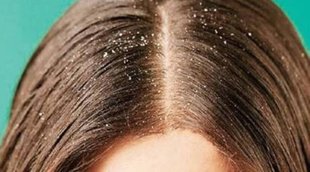 Hair problems, Tips for hair care in hindi, Winter hair care tips, tips for hair, winter hair, dandruff treatment, dandruff in hair,