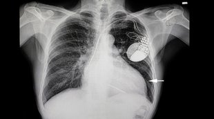 What Causes Fluid on the Lungs,fefdo me pani kyu bhar jata hai, lungs me pani kyu bharta hai, fefdo me pani bharne ka karan,