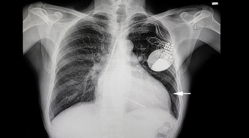 What Causes Fluid on the Lungs,fefdo me pani kyu bhar jata hai, lungs me pani kyu bharta hai, fefdo me pani bharne ka karan,