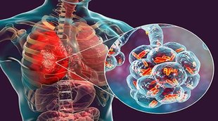 .pneumonia