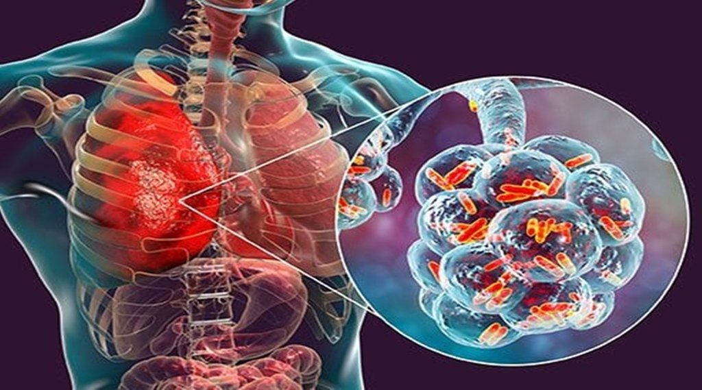 .pneumonia