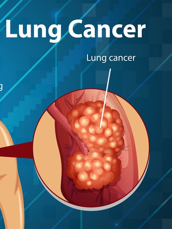 Informative illustration of lung cancer