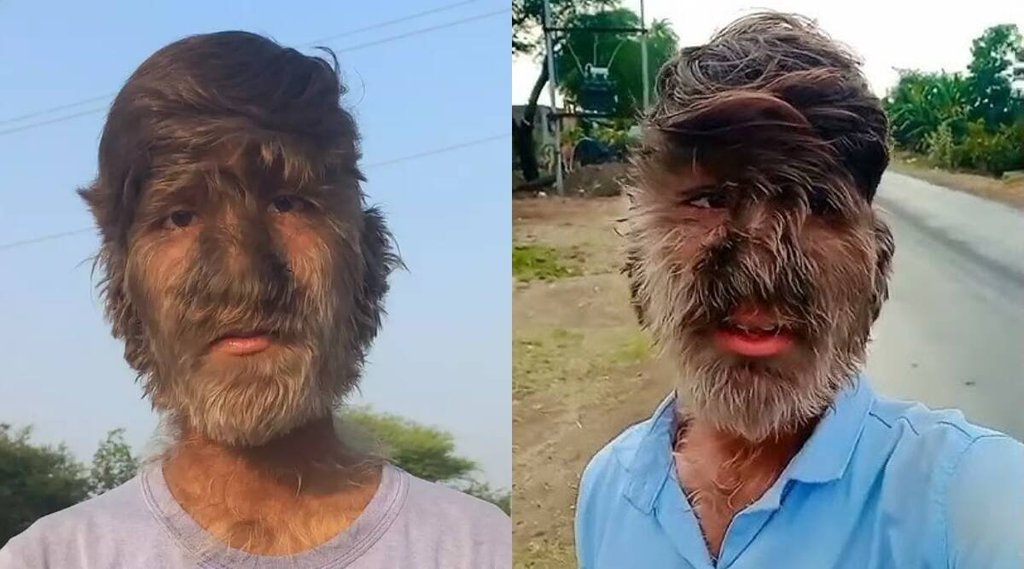 इस बीमारी से पीड़ित इनसान बालों से निजात पाने के लिए शेविंग का सहारा ले सकता है। (Source: Loksatta)