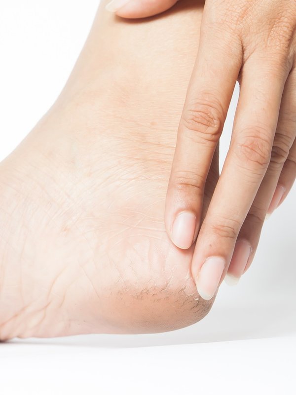 Woman cracked heels with white background, Foot healthy concept