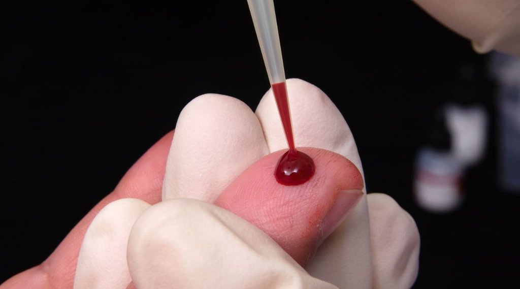 blood clotting symptoms, blood clotting symptoms in hindi, blood clotting causes