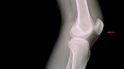 Rishabh Pant: ऋषभ पंत के घुटने का फटा लिगामेंट, जानिए कितना सीरियस है ये और रिकवरी में कितना वक्त लग सकता है