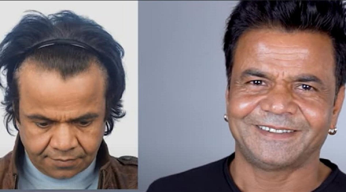 hair transplant experience,lifestyle,lifesyle news,rajpal yadav Hair Transplant