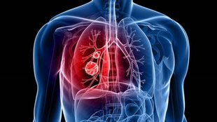 cancer threat | breast cancer| lung cancer|